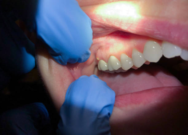 Best Emergency Treatment for Dental Infections or Abscesses in Mont Clare, PA